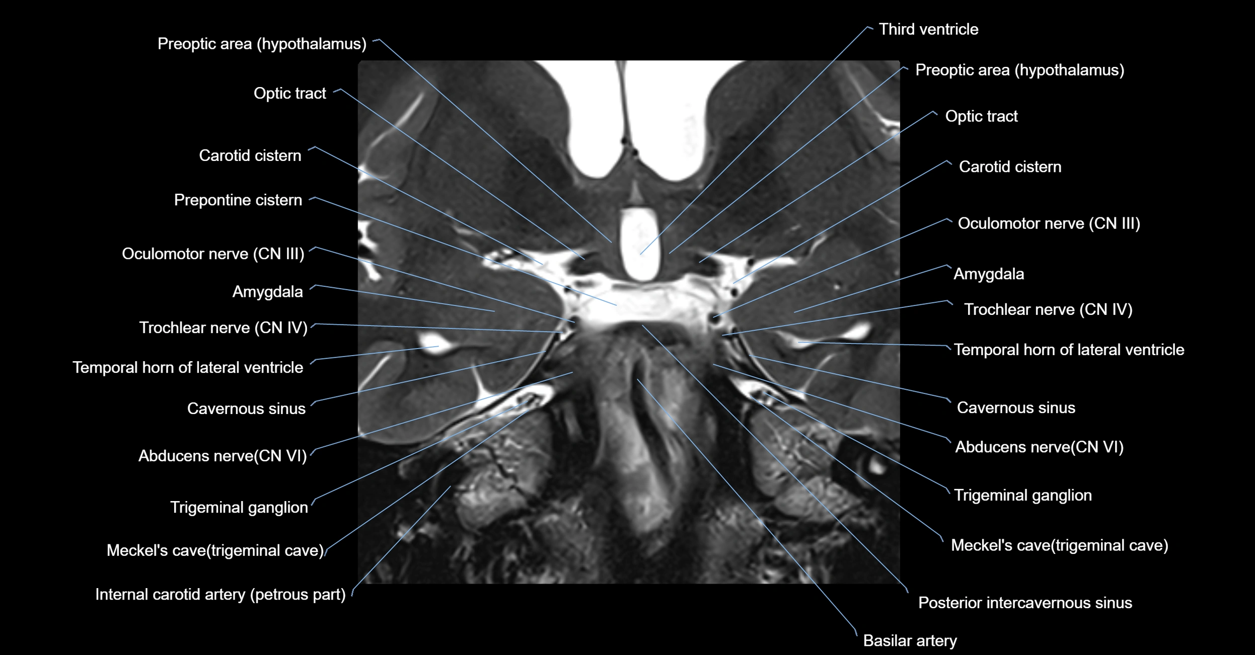 MRI cavernous sinus coronal cross sectional 3T anatomy image-img-00001-00015.webp